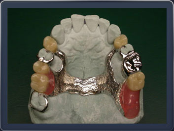 Ортопедическая стоматология (Бюгельный протез)