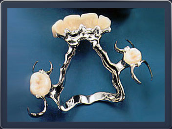 Ортопедическая стоматология (Бюгельный протез)